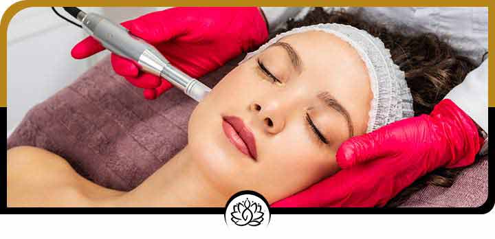 Microneedling Treatment Near Me in Beverly Hills, FL