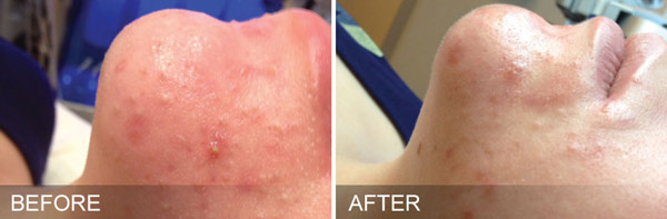 HydraFacial Specialist Near Me in Brandon, FL