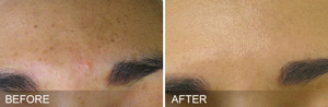 HydraFacial Specialist Near Me in Brandon, FL