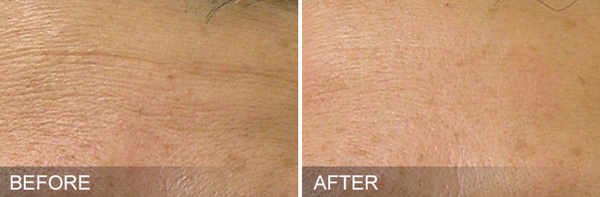 HydraFacial Specialist Near Me in Brandon, FL