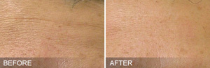 HydraFacial Specialist Near Me in Brandon, FL