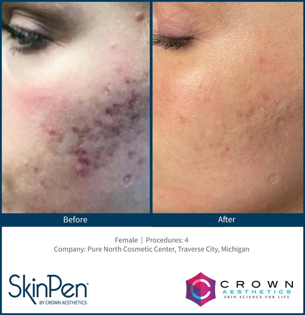 SkinPen Treatment Specialist Near Me in Brandon, FL