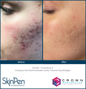 SkinPen Treatment Specialist Near Me in Brandon, FL