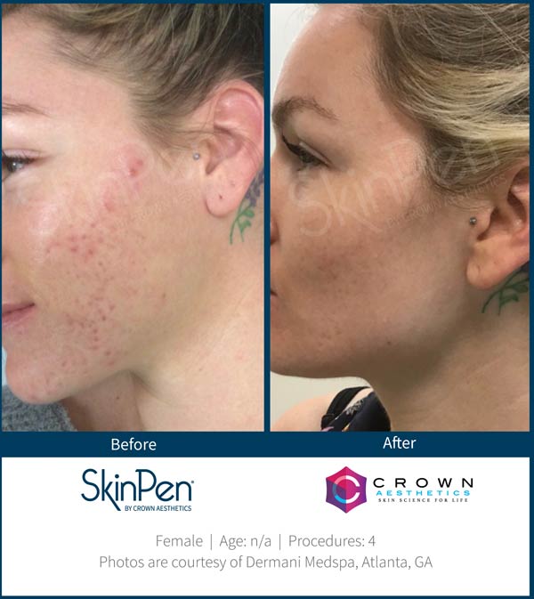 SkinPen Treatment Specialist Near Me in Brandon, FL