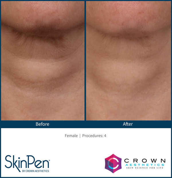 SkinPen Treatment Specialist Near Me in Brandon, FL