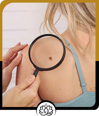Mole Removals  - Balance Med Spa and Salon in Beverly Hills, FL