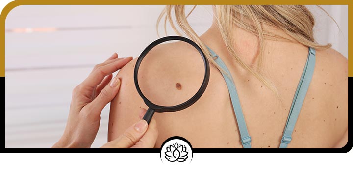 Mole Removals Specialist Near Me in Beverly Hills, FL
