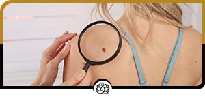 Mole Removals Specialist Near Me in Beverly Hills, FL