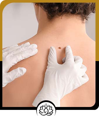 Skin Tag Removal - Balance Med Spa and Salon in Beverly Hills, FL