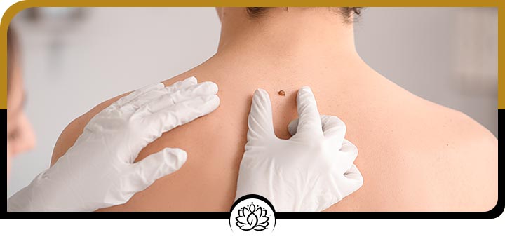 Skin Tag Removal Specialist Near Me in Beverly Hills, FL