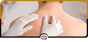 Skin Tag Removal Specialist Near Me in Beverly Hills, FL